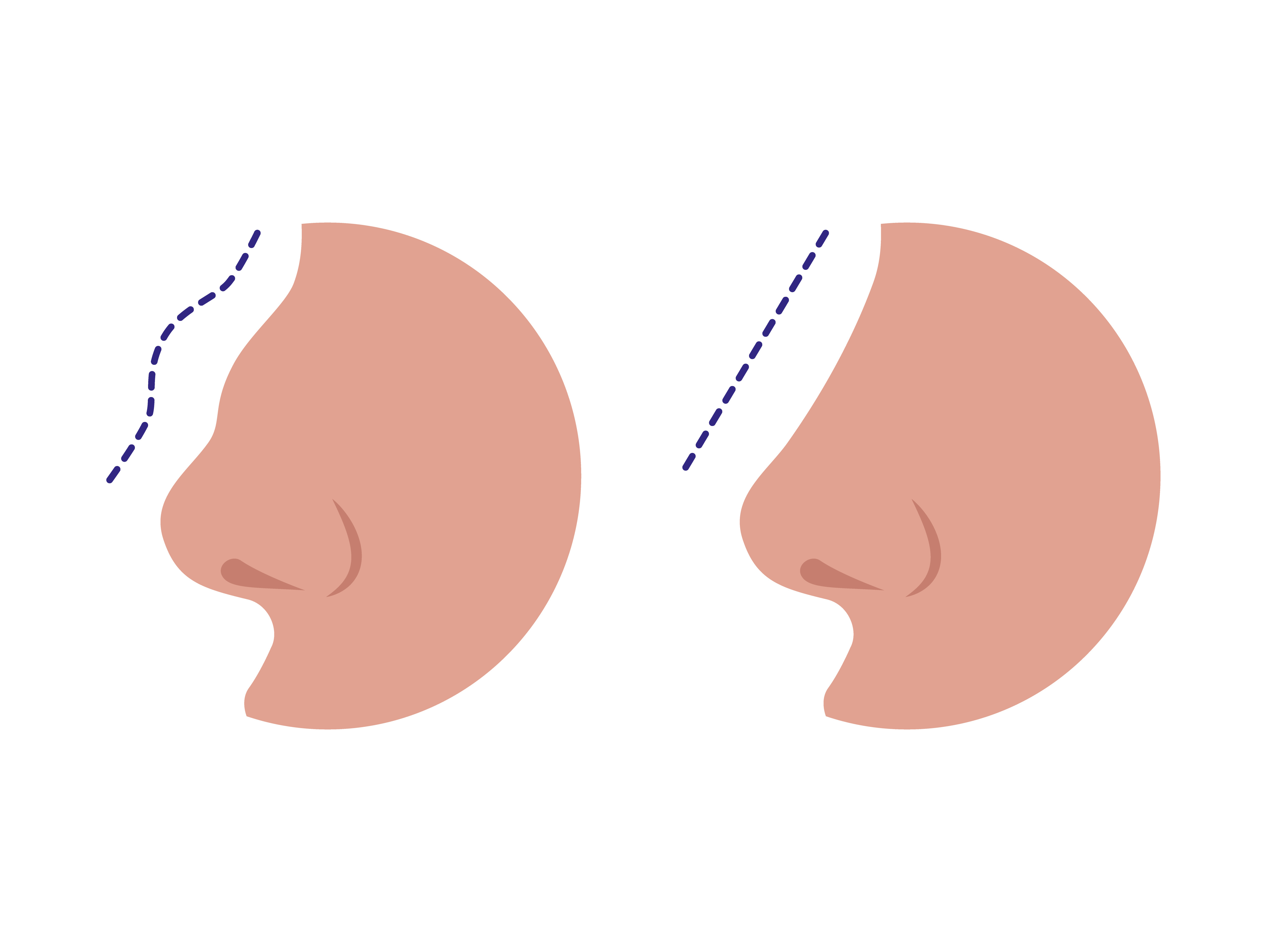 Septorynoplastyka (korekta nosa zewnętrznego i przegrody nosa)